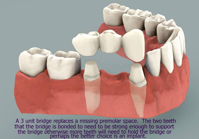 dental bridge, Langley Dentist